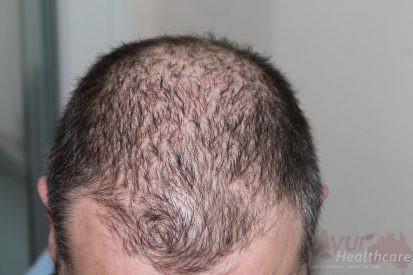 hair-loss-ayurvedic-treatment