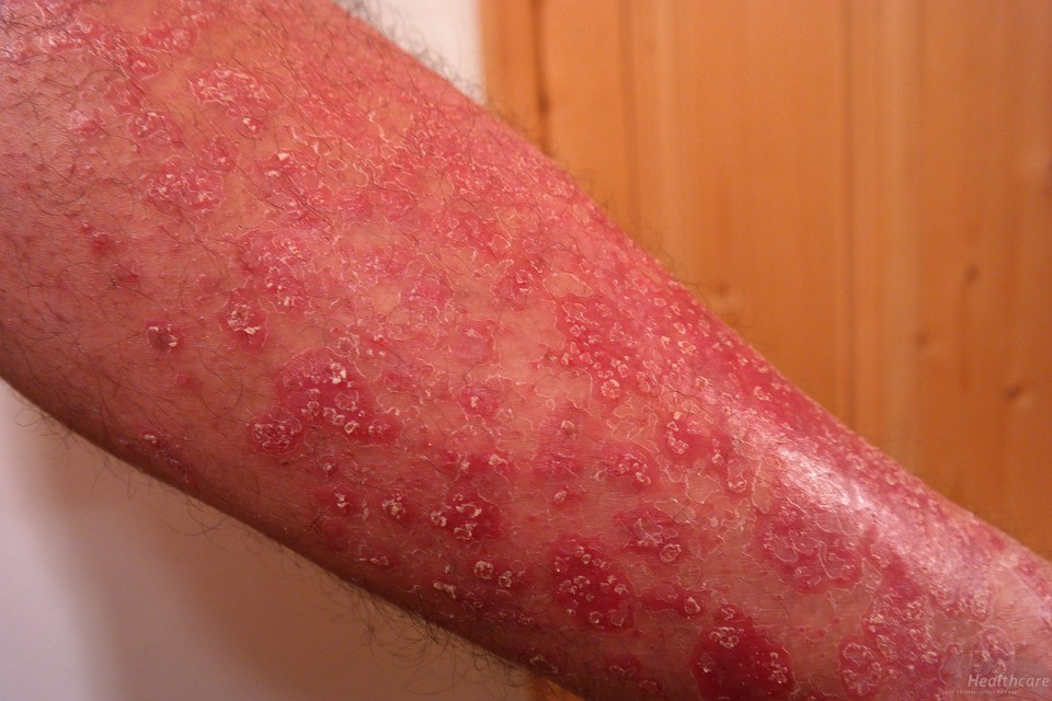 Ayurveda Treatment for Psoriasis Psoriasis Treatment Australia