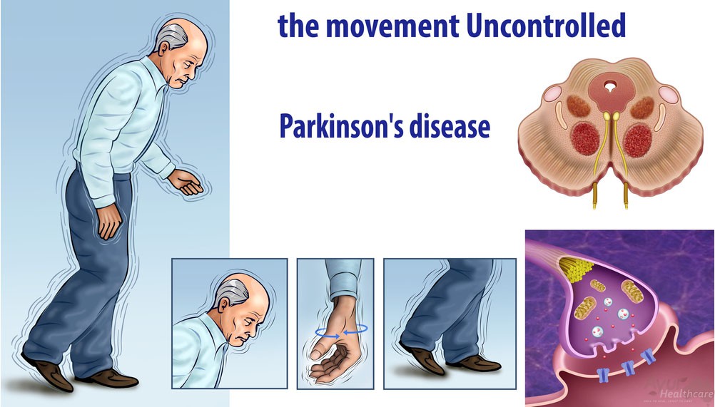 parkinsons