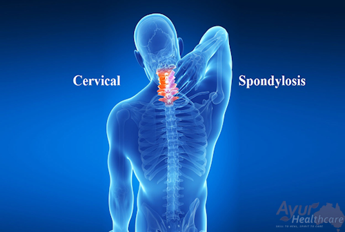 Spondylosis - Ayur Healthcare