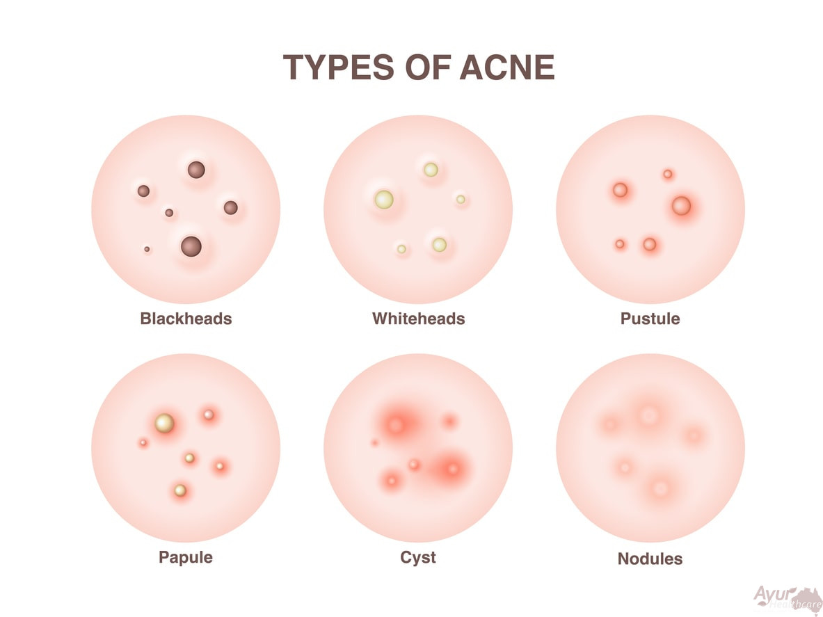 Ayurvedic Treatment for Acne