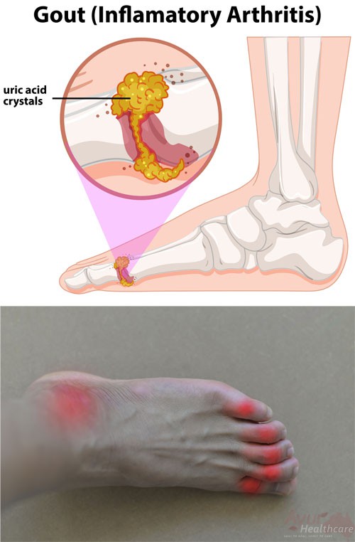 gout treatment