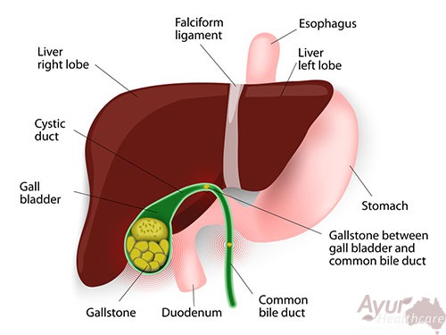 Multiple Calculi In Gall Bladder Means