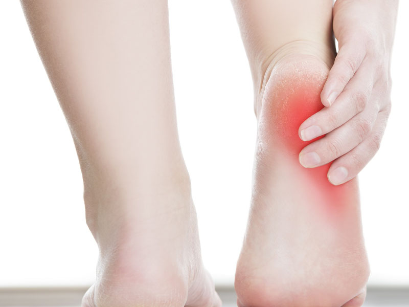 7 Natural Home Remedies for Heel Spurs to Relieve the Pain - NDTV Food