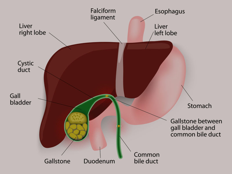 Gallbladder-Stones-Ayurvedic-Treatment