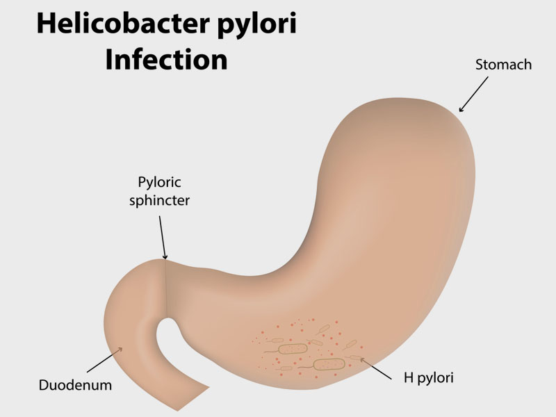 Hyperacidity-Helicobacter-pylori-Infection