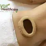 Katibasti Treatment