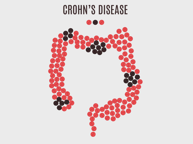 crohns-disease
