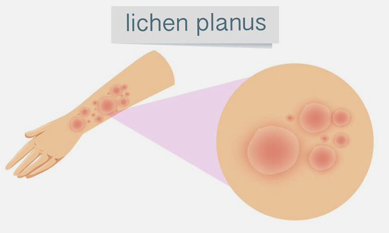 lichen-planus